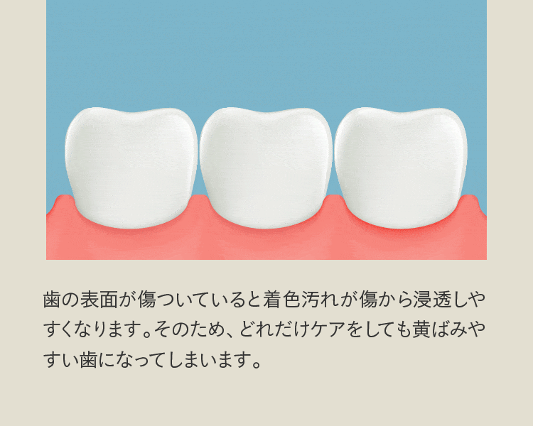 歯の表面が傷ついていると着色汚れが傷から浸透しやすくなります。そのため、どれだけケアをしても黄ばみやすい歯になってしまいます。