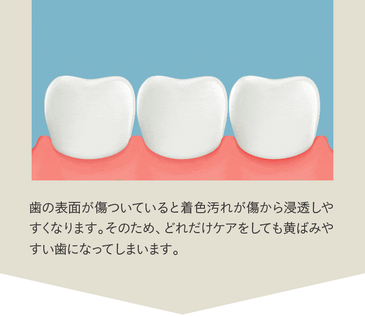 歯の表面が傷ついていると着色汚れが傷から浸透しやすくなります。そのため、どれだけケアをしても黄ばみやすい歯になってしまいます。